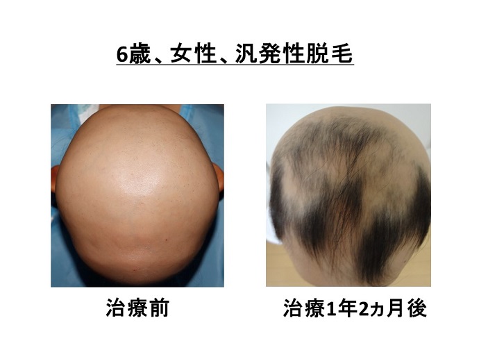 円形脱毛症　病院